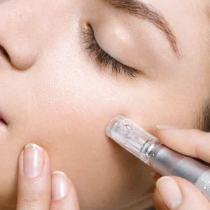 microneedling