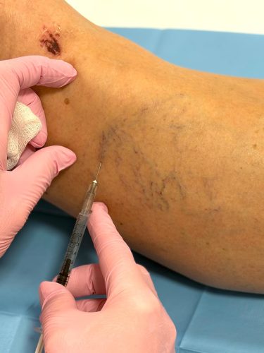 scleroterapie